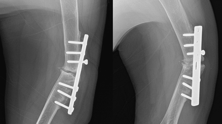 Shoulder Mechanics