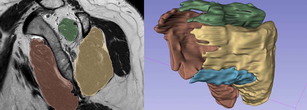AI-based shoulder X-ray/MRI analysis